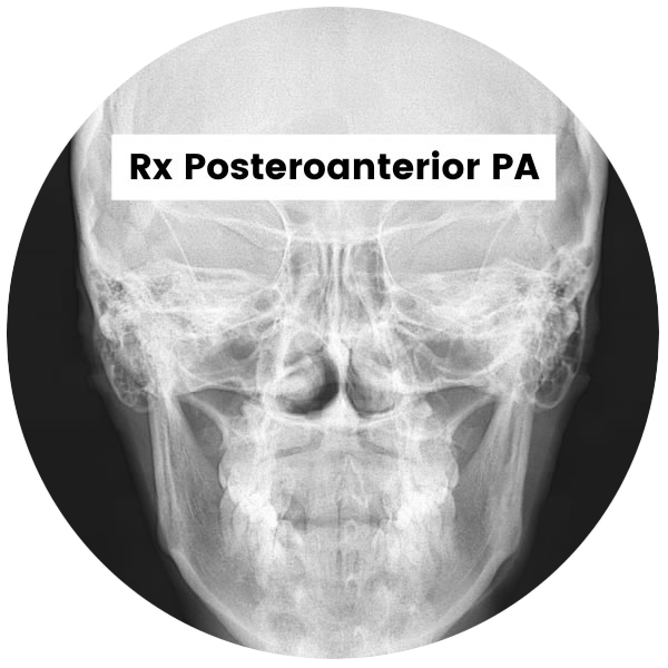 Rx Postero anterior