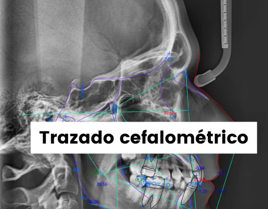 Trazado Cefalometrico
