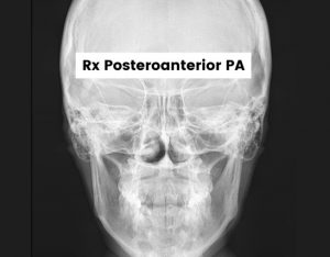 rx posteroanterior pa