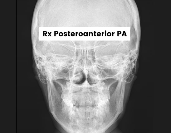 rx posteroanterior pa