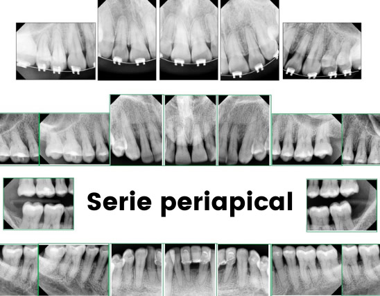 serie periapical